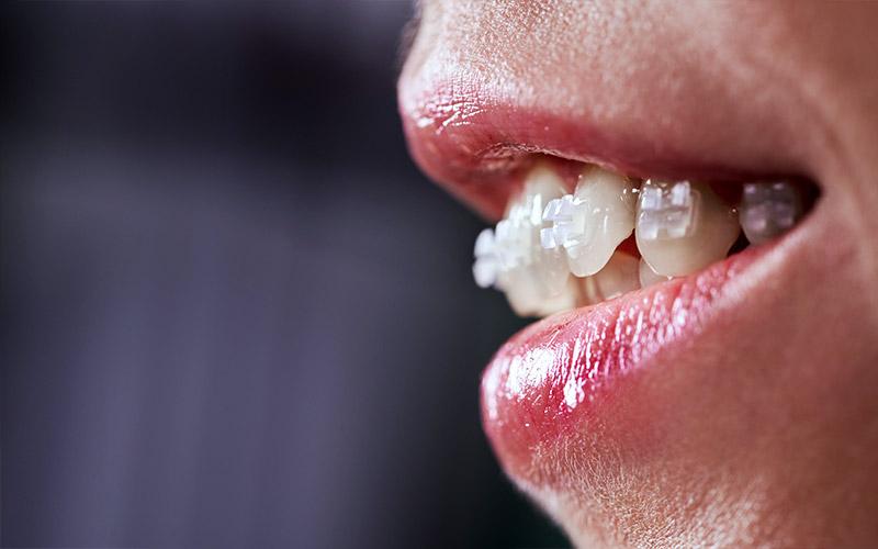 braces in vaughan | dental braces before and after