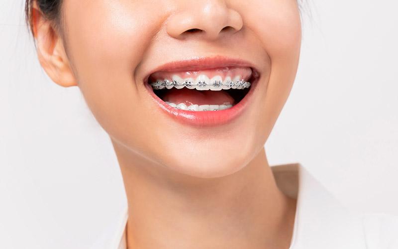 orthodontics in vaughan